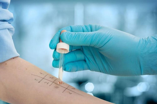 Skin Prick Testing (SPT)