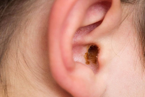 Ear blockage and wax-related problems