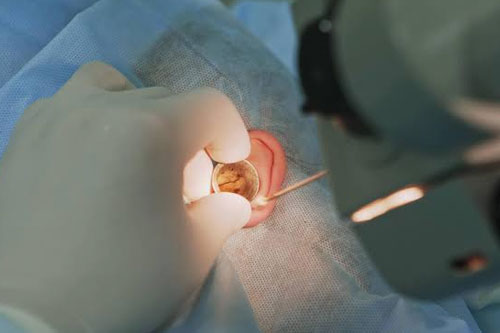 Ear surgery