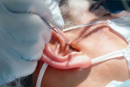 Eardrum and middle-ear procedures