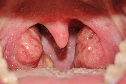 Tonsil and adenoid surgery