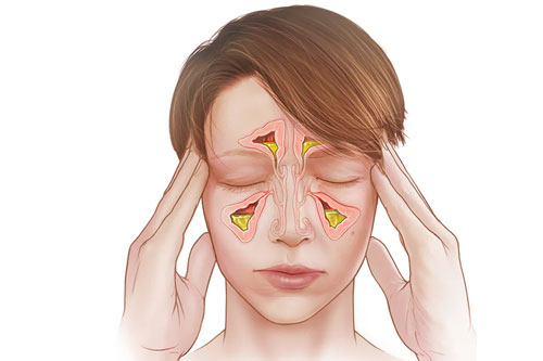 Sinusitis