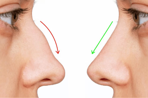 Deviated Nasal Septum