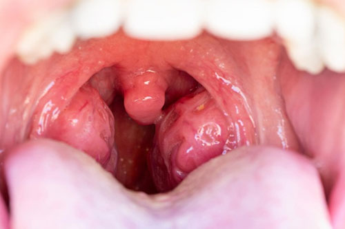 Tonsillitis and enlarged tonsils in children