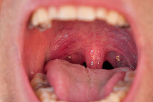 Tonsillitis & Tonsil Stones