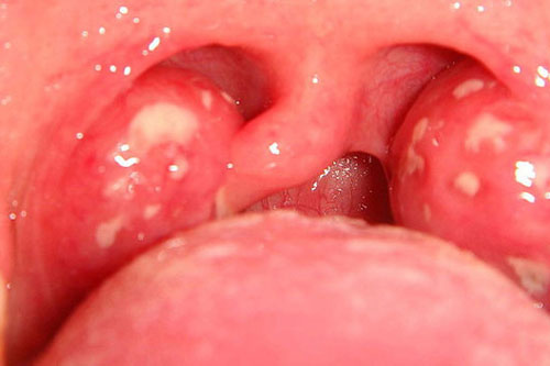 Throat Infections