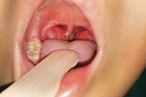 Chronic Throat Irritation